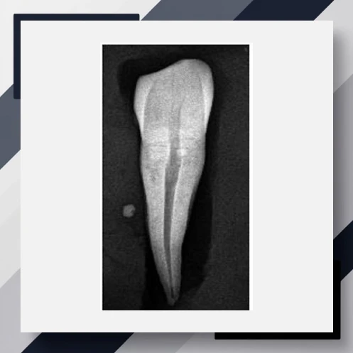 Single-Rooted Teeth Age Estimation