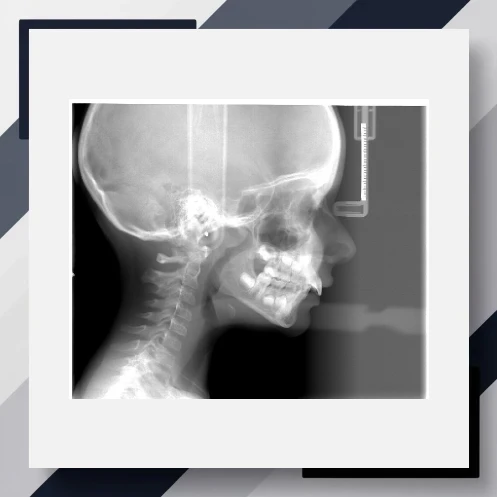 Pubertal Growth Spurt Estimation